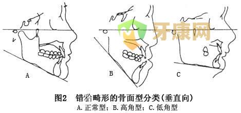 牙齿矫正和正颌手术矫正哪个更好？