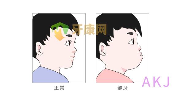 龅牙