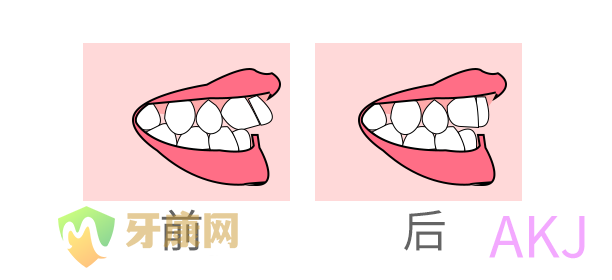 牙齿前突