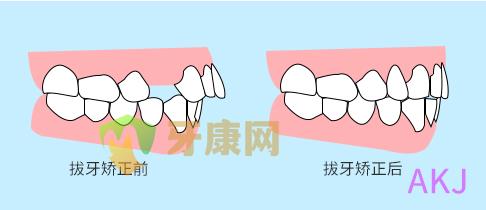 龅牙矫正