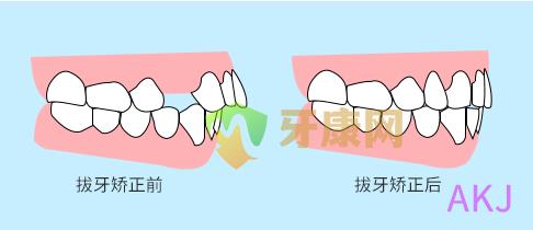 龅牙