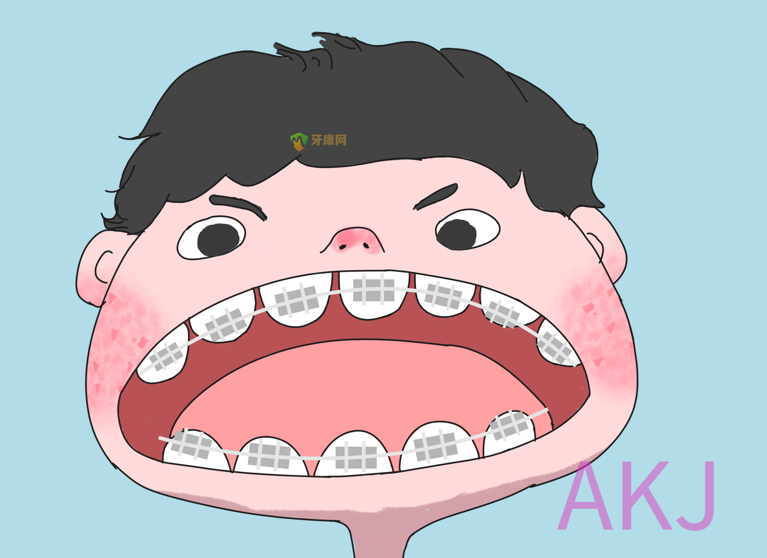 牙套