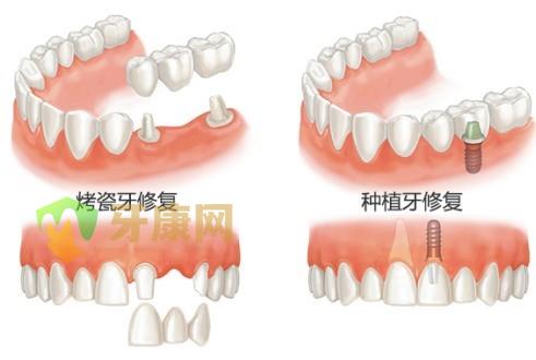 烤瓷牙容易产生的危害有哪些？