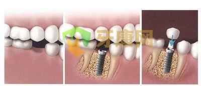 拔除牙齿后多长时间可以镶牙种植牙