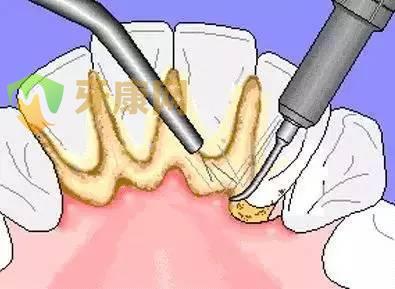 洗完牙为什么还会长牙结石