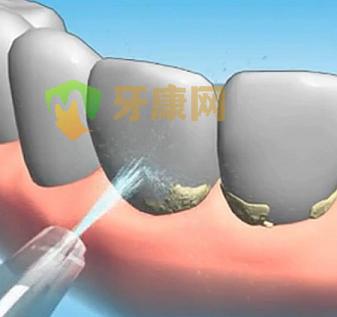 有牙石该洗牙吗