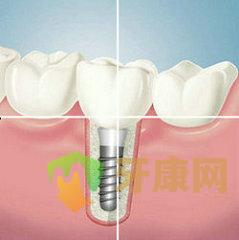 种植牙的修复特点