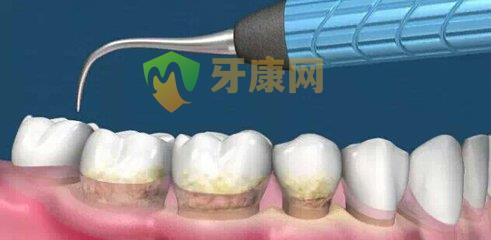 超声波洗牙会难受吗