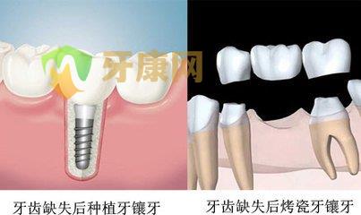 什么情况下镶牙必须磨牙