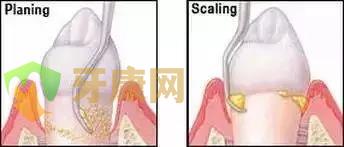 龈下刮治