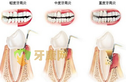 牙周炎洗牙要多少钱？