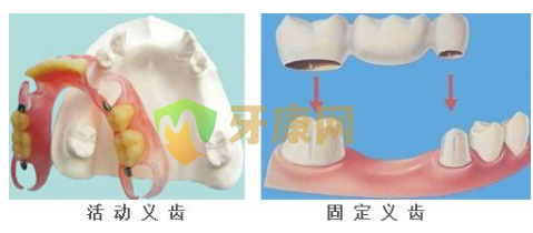 影响镶牙的使用寿命的几个因素　