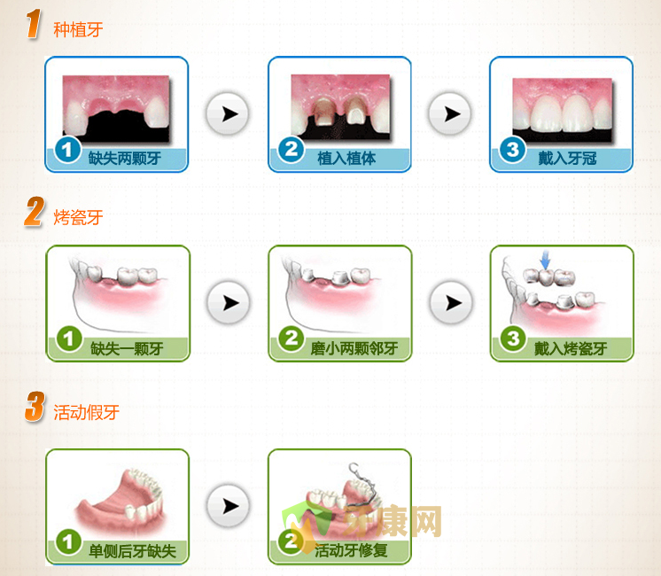 镶牙用什么方法较快？