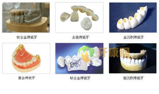 哪些人适合做金沉积烤瓷牙