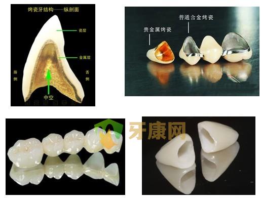 常用的烤瓷修复种类有哪些？