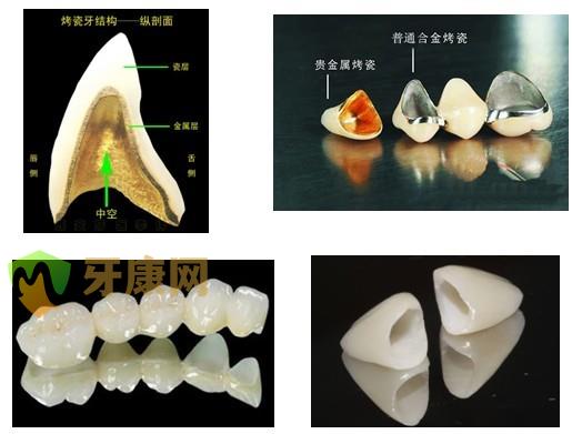 目前比较好的烤瓷牙材料是什么