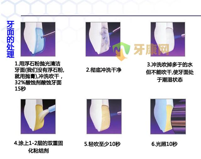 瓷贴面是怎么做的？图解瓷贴面修复过程