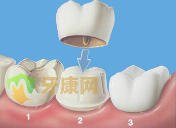 做了烤瓷牙，一辈子都只能做烤瓷牙吗？