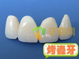  深圳烤瓷牙可以修复瓜子牙吗