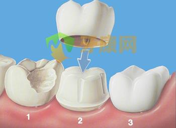  钯银烤瓷牙是怎么做的？