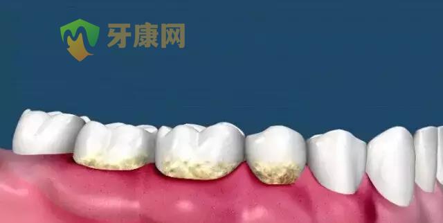牙龈红肿