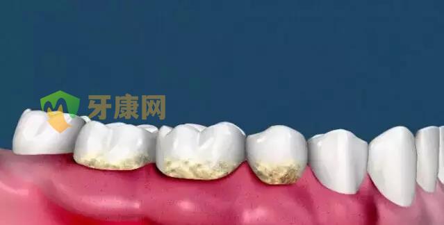 牙龈红肿