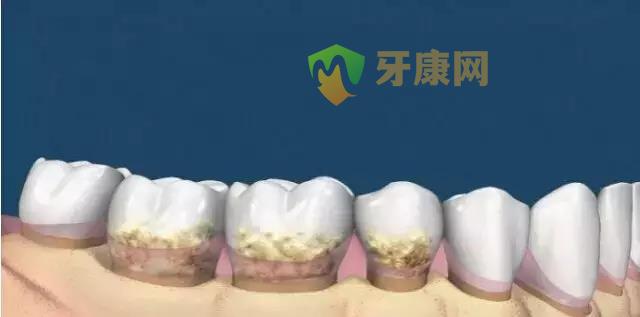 牙结石形成