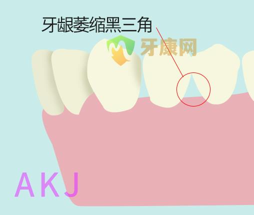 牙龈萎缩