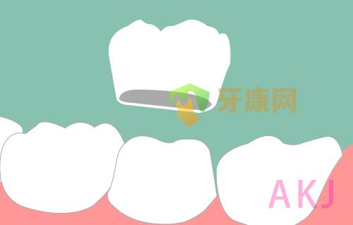 烤瓷牙