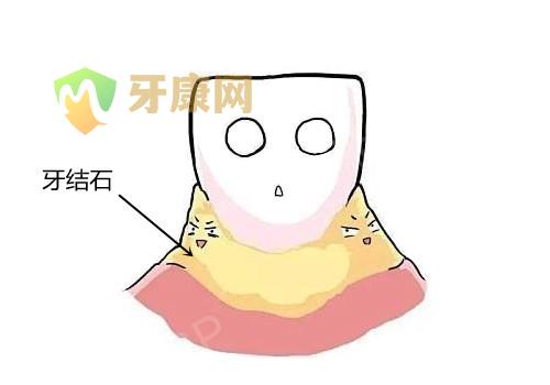 牙结石