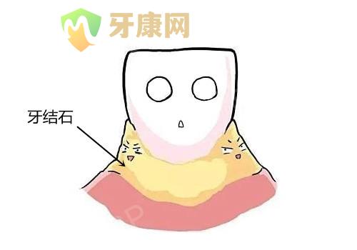 牙结石
