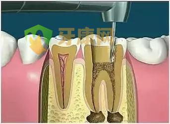 根管治疗过程
