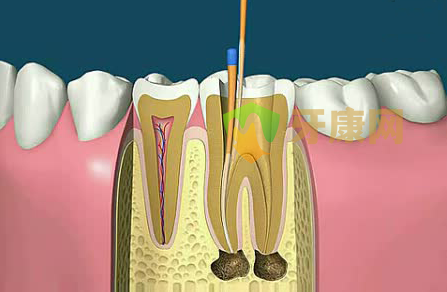 牙髓炎能拔牙吗