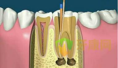 牙齿根管治疗后瘘管未愈合怎么办