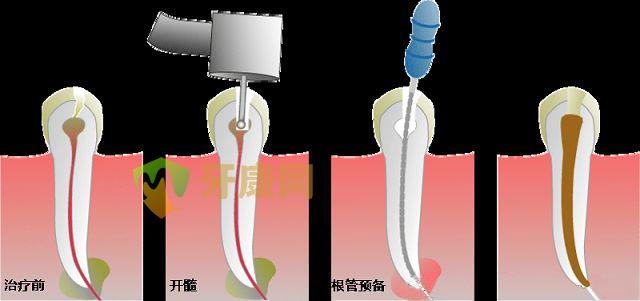 深圳根管治疗怎么样