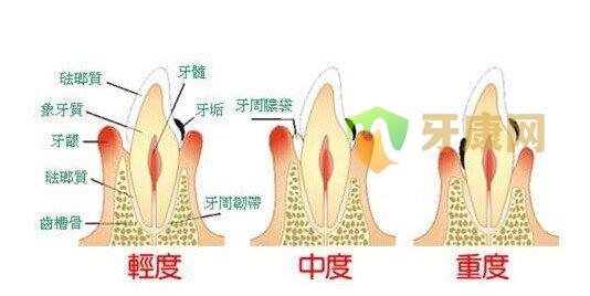 什么是牙周炎