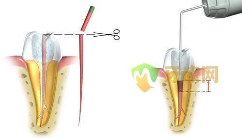 什么是根管治疗