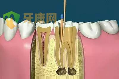 根管治疗的作用