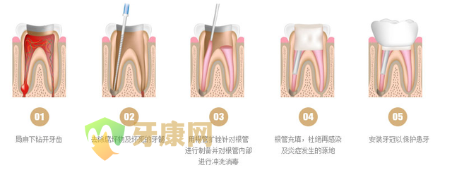 根管治疗的价格