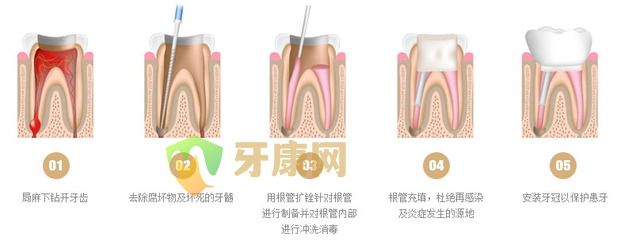 根管治疗多少钱