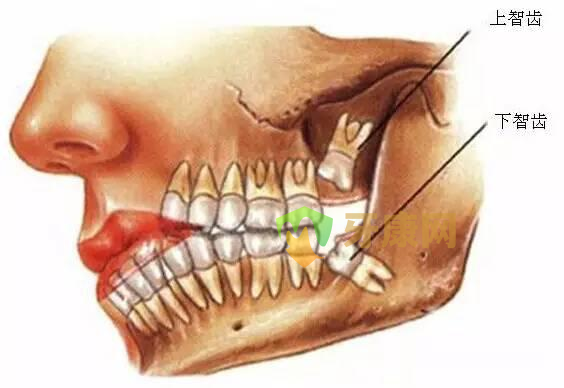 阻生智齿怎么办