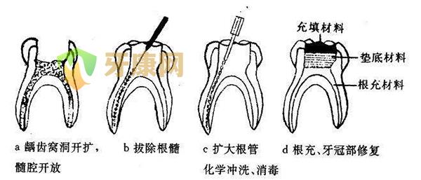 儿童根管治疗