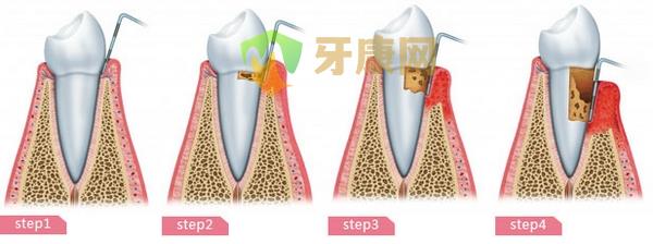 牙周炎需要洗牙吗