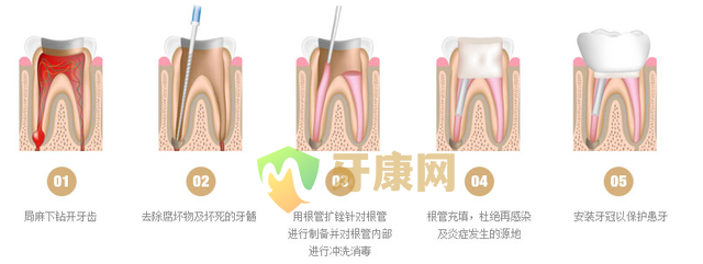 根管治疗后牙痛的原因