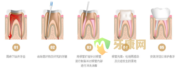 根管治疗的危害