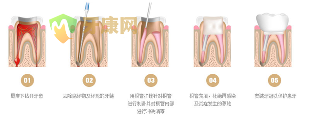 根管治疗的作用