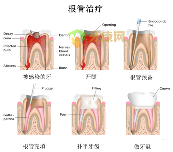 根管治疗的注意事项