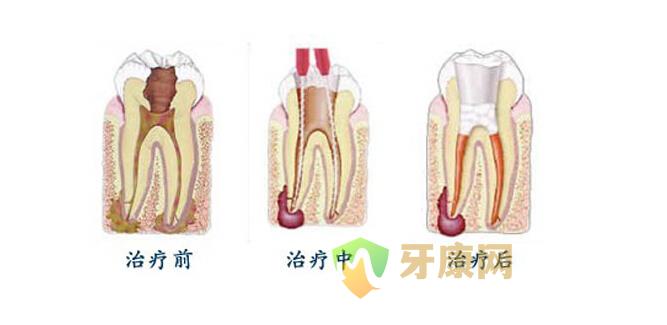 根管治疗后多久做烤瓷牙