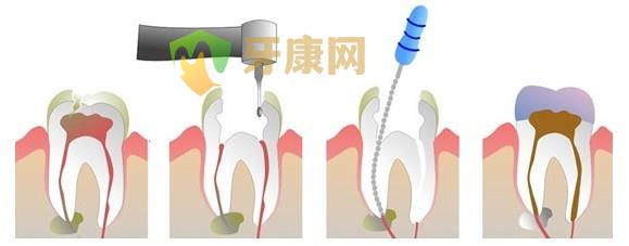 根管治疗的作用是什么