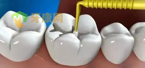 根管治疗后牙痛的原因是什么